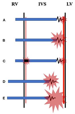 Which Is More Likely to Achieve Cardiac Synchronization: Left Bundle Branch Pacing or Left Ventricular Septal Pacing?